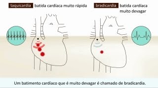 Arritmia  O que é isto [upl. by Amitak666]