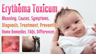 Erythema toxicum overview causes sign and symptoms treatment prevention home remedies FAQs [upl. by Thomey575]