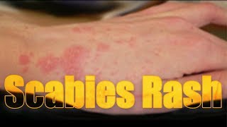 Scabies Rash itchy highly contagious skin disease  Usapang pangkalusugan [upl. by Nnyrat]