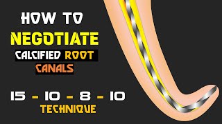 How to negotiate calcified root canals [upl. by Carew]