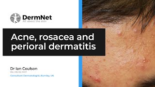 Acne Rosacea and Perioral Dermatitis [upl. by Atsillak]