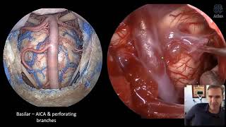 Chordomas and Chondrosarcomas Surgical Anatomy and Technical Nuances [upl. by Yelah435]