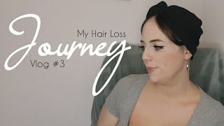 My Hair Loss Journey  Alopecia Vlog 3 Areata amp Ophiasis [upl. by Ostraw]