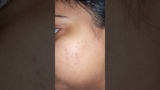 adapalene gelhow I used to cure my acne [upl. by Ellyn]