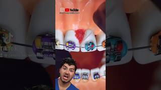 Braces Flossing Hack [upl. by Violante]