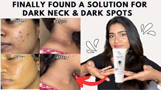 Dark neck amp Hyperpigmentation treatment  Acanthosis Nigricans treatment [upl. by Brad691]