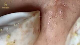 Loan Nguyen Acne Treatment 1651mh [upl. by Bendick348]