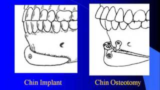 Large Chin Augmentation with Dr Barry Eppley [upl. by Okier]