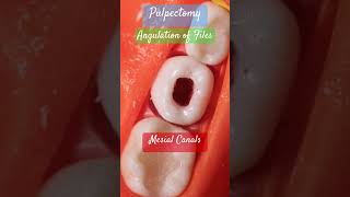 Angulation of files 🟣 Mesial amp Distal Canals 🟤 PULPECTOMY [upl. by Ijok]