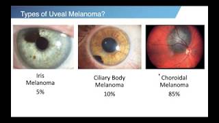 Ocular Melanoma Innovative Treatments and Beyond [upl. by Aidil]