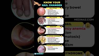 5 Nail Changes You Should NEVER Ignore  Nail signs of Disease nail nailhealth shortsfeed [upl. by Eedak]