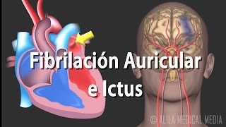 Fibrilación Auricular e Ictus Animación Alila Medical Media Español [upl. by Enicnarf]