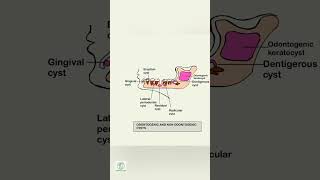 ODONTOGENIC AND NON ODONTOGENIC CYSTdental dentalschool mouth [upl. by Hedvah24]