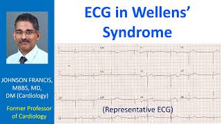 ECG in Wellens’ Syndrome [upl. by Aillimac]