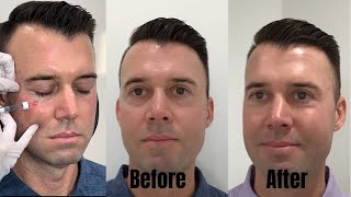 How to get rid of under eye darkness Under eye restoration with fillers [upl. by Adnarram376]