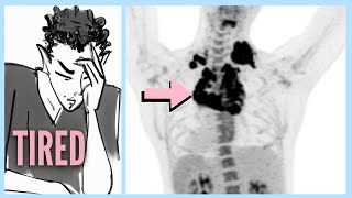 LYMPHOMA After Ignoring 6 WARNING Signs [upl. by Tristas]