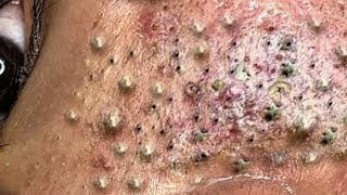 Big Cystic Acne Blackheads Extraction Blackheads amp Milia Whiteheads Removal Pimple Popping  523 [upl. by Gael]