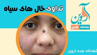 Mole removal with laser برداشتن خال سیاه با لیزر [upl. by Marguerita]