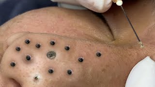 Big Cystic Acne Blackheads Extraction Blackheads amp Milia Whiteheads Removal Pimple Popping  1063 [upl. by Aninay]