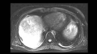 Large hepatocellular carcinoma HCC [upl. by Ecirahc136]