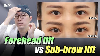 Facelift FAQ Endoscopic Forehead Lift Vs Subbrow Lift [upl. by Godric131]