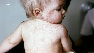 Your child has a viral rash but which one is it Here’s a comparison [upl. by Ellga408]