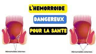 L’HEMORROIDE DANGEREUX POUR LA SANTE SUIVEZ JUSQU’A LA FIN [upl. by Yelwar]