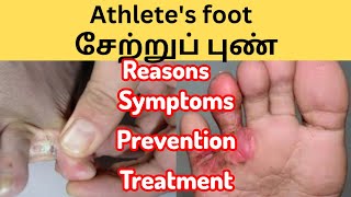 Athlets foot சேற்றுப்புண் அறிகுறிகள் சிகிச்சை தடுப்பு முறை [upl. by Suh]