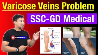 SSC GD Medical Varicose Veins points 😳 Problem Solved 🤗😉 SSC GD Medical Test 2024 [upl. by Rene]