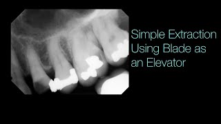 Simple Upper Premolar Extraction using the Blade to Widen the PDL Space [upl. by Cenac]