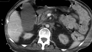 Left renal artery stenosis [upl. by Namyl]