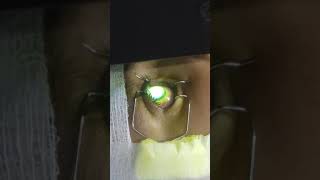 cxl treatment for keratoconus [upl. by Hanae]