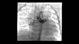 Transcatheter occlusion of a coronary cameral fistula with Amplatzer Vascular Plug II [upl. by Eiramoj]