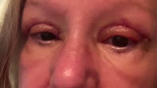 Blepharoplasty Surgery [upl. by Mcfarland]