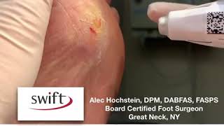 Swift Verrucae Treatment with Dr Hochstein [upl. by Ariaj]