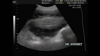 Ascite tuberculeuse Dr ACHIBET [upl. by Telrats]