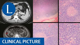 Radiation pneumonitis and chemotherapy in a patient with multiple myeloma [upl. by Etty267]