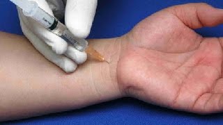 Cortisone Injections for Carpal Tunnel [upl. by Gschu]