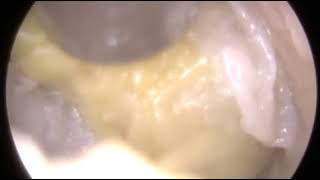 Otitis Externa and Discharge Removal  Ep 300 [upl. by Kaehpos]