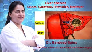 Liver abscess  लिवर एब्सेस रोग क्या है  यकृत फोड़ा  Dr Hardeep Bains [upl. by Zsamot397]