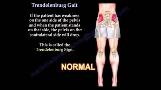 Trendelenburg Gait Everything You Need To Know Dr Nabil Ebraheim [upl. by Stoll]