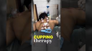 Cupping Therapy Cost 😳 amp Benefits 🙂‍↕️ [upl. by Floro]