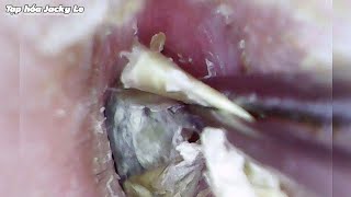 Ear Wax Removal 110 Itching All Day Because Of Dry And Thick Earwax  Ear Cleaning ASMR [upl. by Eelimaj]