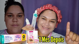 Resultado de 1 Mês Usando NistatinaÓleo de Rosa Mosqueta Pra Clarear Melasma e Manchas da Pele Acne [upl. by Yelkao]