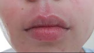 How to get rid of Perioral Dermatitis [upl. by Eirovi399]