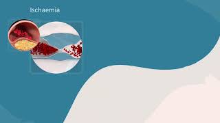 Systemic thromboembolism [upl. by Weiler]