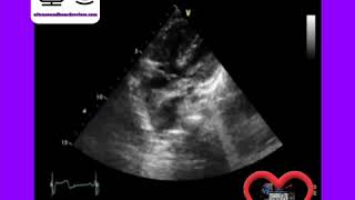 Tetralogy of Fallot [upl. by Nicolella]