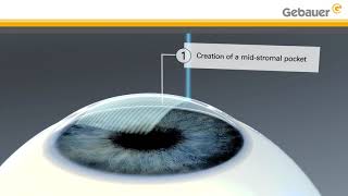 Keratoconus treatment using LIKE midstromal pocket  Lenticular Intrastromal Keratoplasty [upl. by Zsa119]