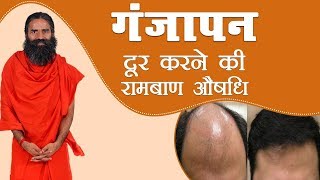 गंजापन  Baldness दूर करने की रामबाण औषधि  Swami Ramdev [upl. by Todd44]