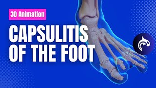 Capsulitis  Pain in the Ball of the Foot [upl. by Minsat827]